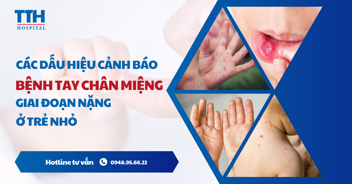 Các Dấu Hiệu Cảnh Báo Bệnh Tay Chân Miệng Giai Đoạn Nặng Ở Trẻ Nhỏ